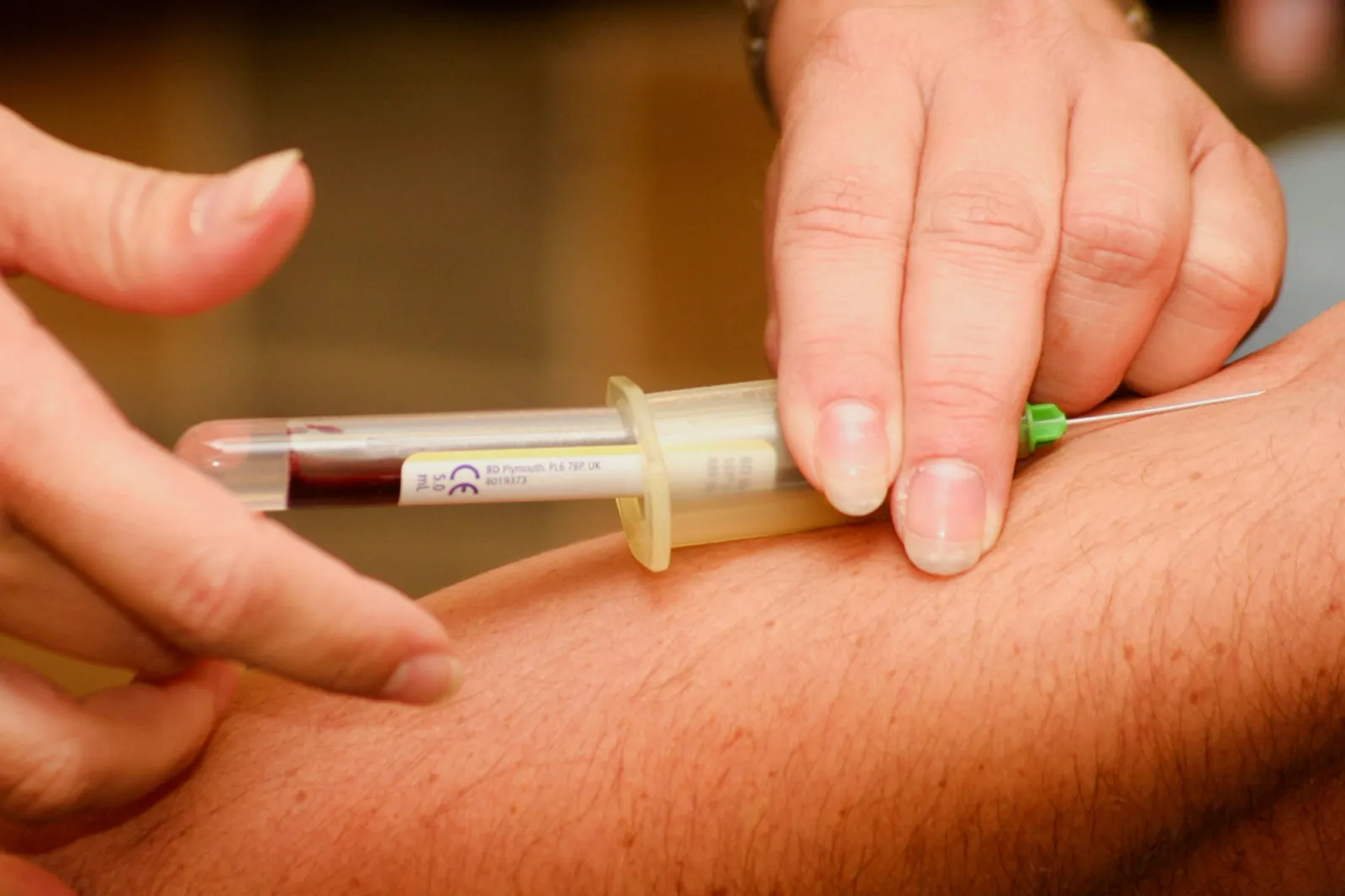 Coleta de sangue a vácuo no braço de um paciente, com o tubo já parcialmente cheio